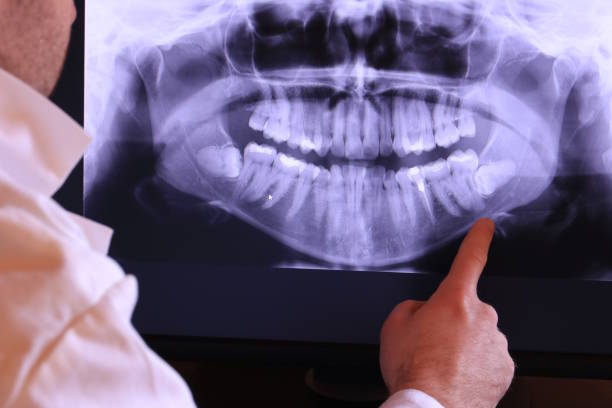 Best Emergency Dentist for Lost Fillings or Crowns in Morrisville, NY